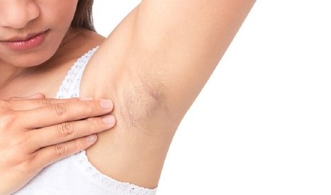 Hal-hal yang Perlu Dipertimbangkan saat Memilih Deodorant untuk Memutihkan Ketiak 